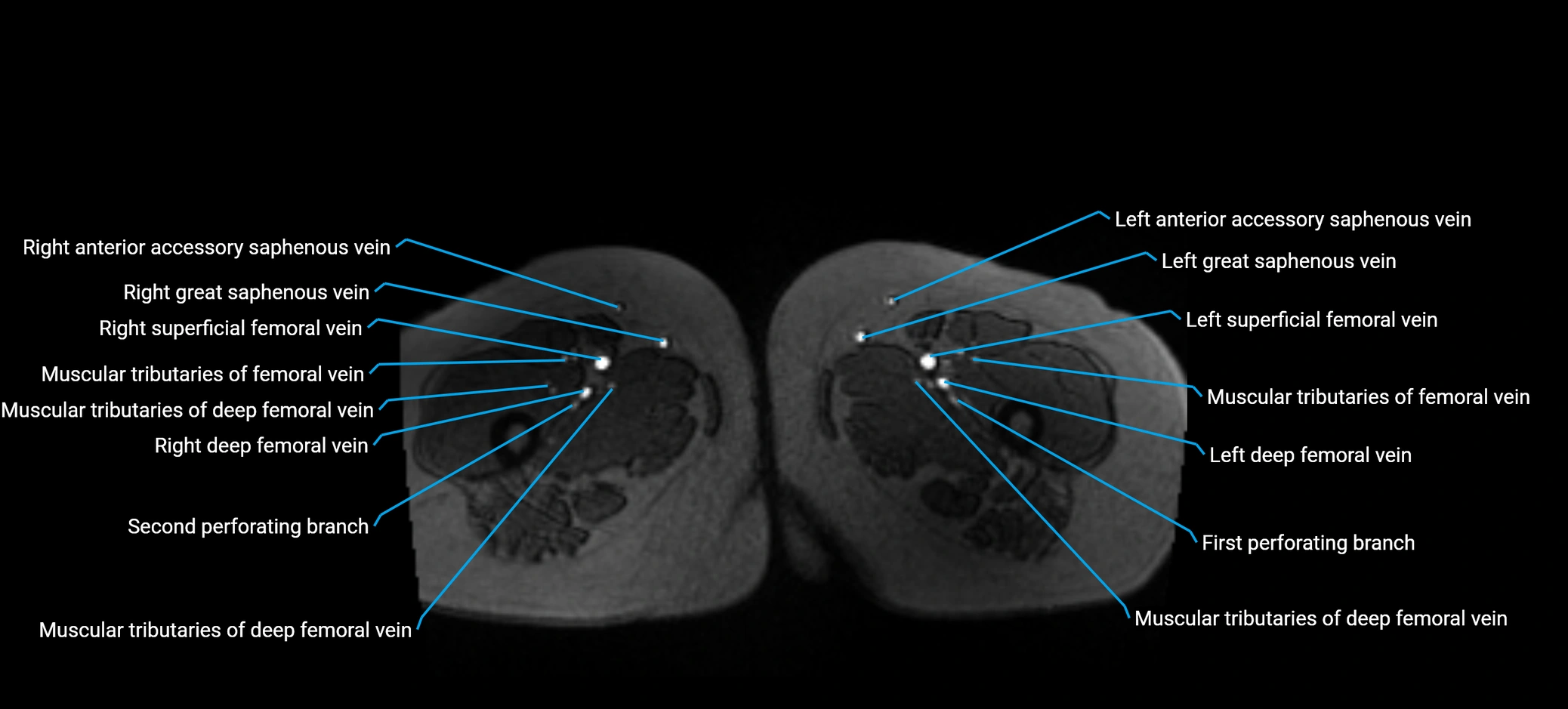 MRV abdomen pelvis & lower limb axial cross sectional anatomy labelled MRI image 224 (1).webp